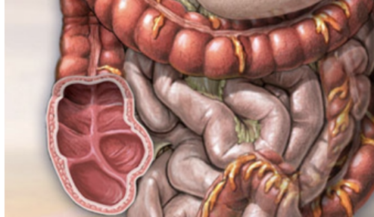 COLON CANCER: THE SILENT KILLER